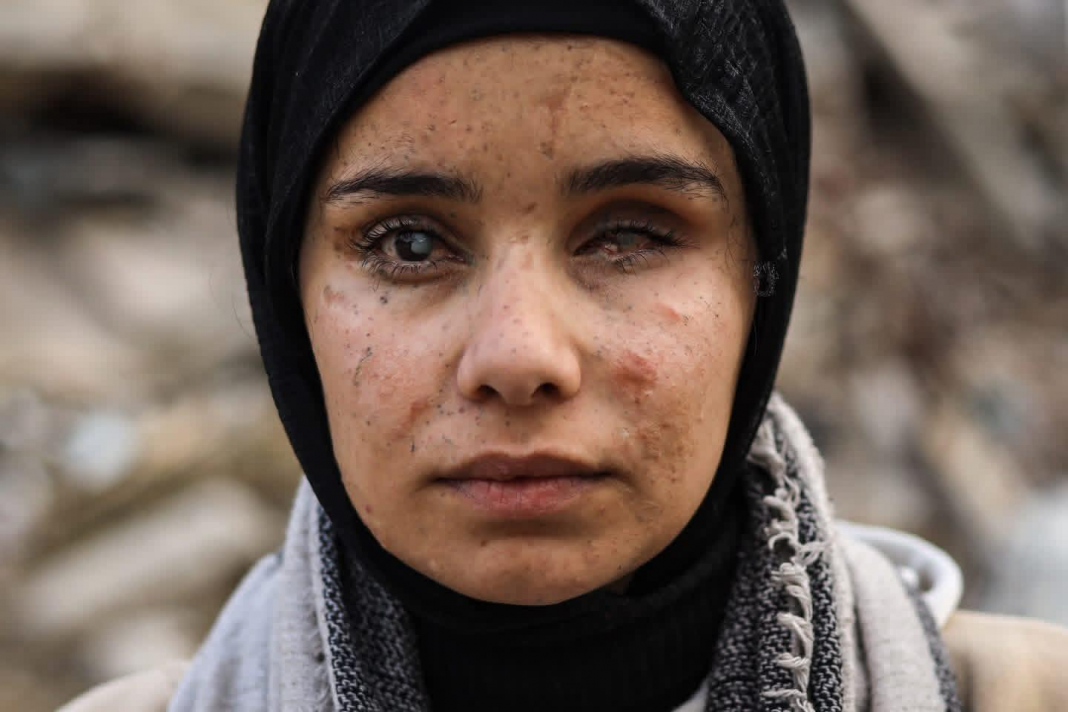 Farah Mahmoud al-Kahlud, 17 ans, qui a perdu une jambe et un œil lors d'une attaque israélienne contre sa maison à Jabalia